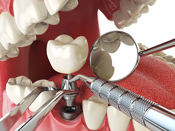 Best Emergency Root Canal Treatment in Granite, OK